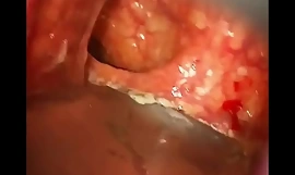 Anal surgery